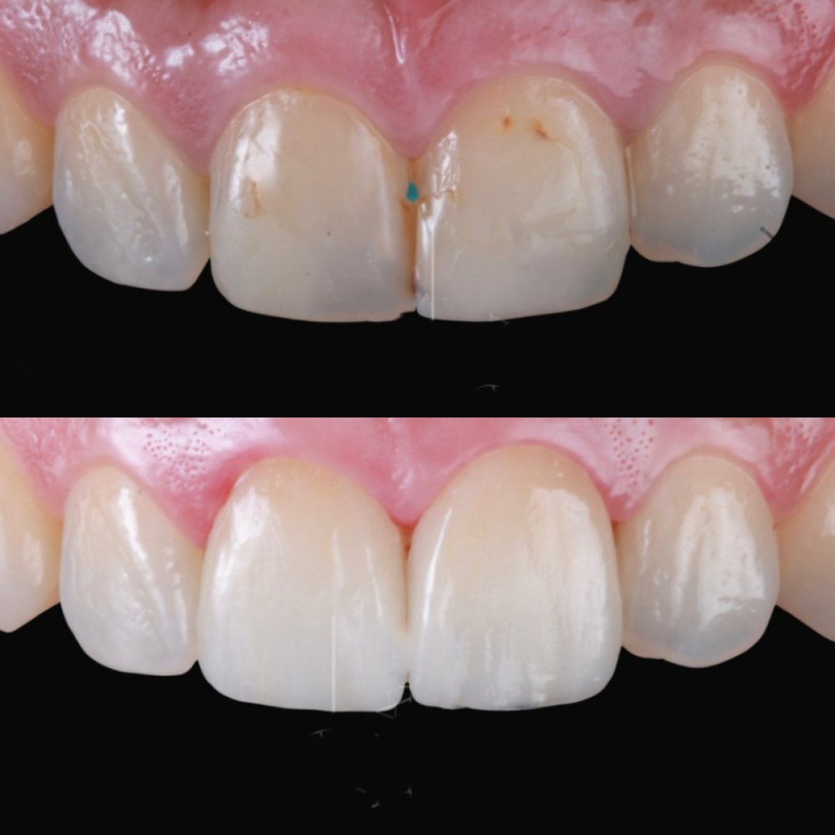 نتائج قبل وبعد الفينير في RO Dental Clinic – تحسين جمالية وبياض الأسنان