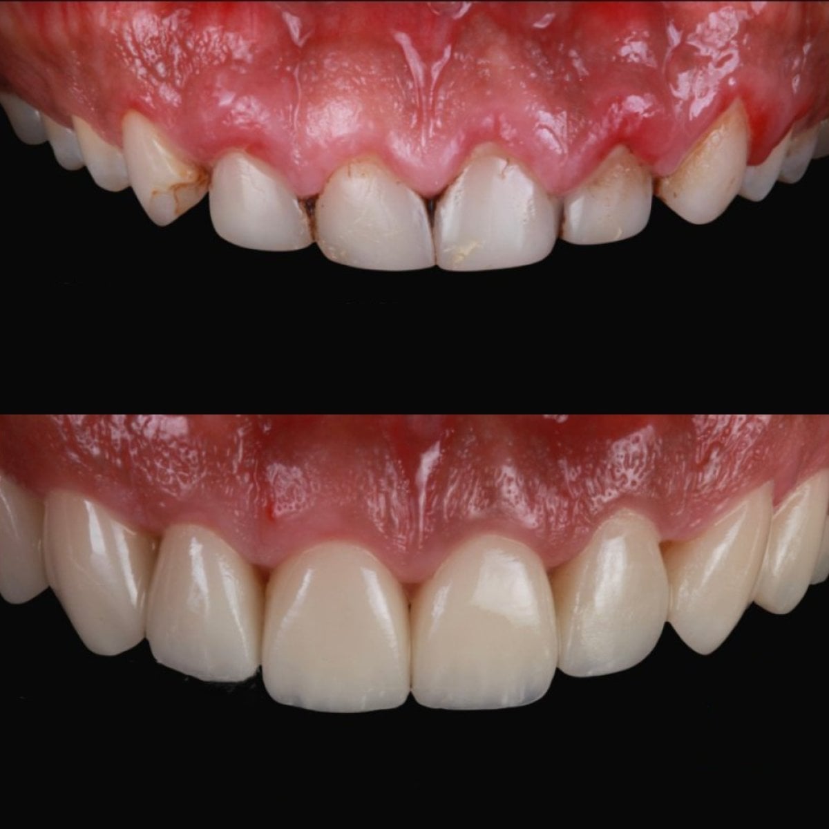 Before and after veneers at RO Dental Clinic – improved smile aesthetics and whiter teeth result