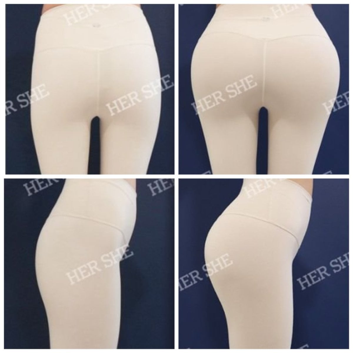 Resultados antes y después de Brazilian Butt Lift en HERSHE Plastic Surgery Korea, curvas mejoradas