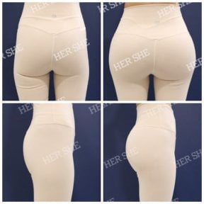 Before and after Brazilian Butt Lift results at HERSHE Plastic Surgery Korea, enhanced curves
