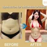Vorher-nachher-Ergebnis der Bauch-Liposuktion bei ID Clinic Bangkok, Körperkontur