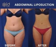 Before and after Vaser abdominal liposuction results at ID Clinic Bangkok, slimmer waistline