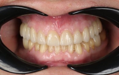 Ergebnis Zahnimplantat bei Dental Clinic Dynasty Stomatology Prag, restaurierte obere Zähne