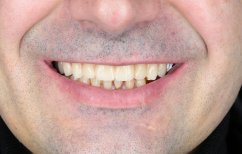 Ergebnis Zahnimplantat bei Dental Clinic Dynasty Stomatology in Prag, verbesserte Zahnästhetik