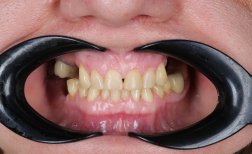 Vor Zahnimplantat bei Dental Clinic Dynasty Stomatology in Prag, sichtbare Zahnlücken
