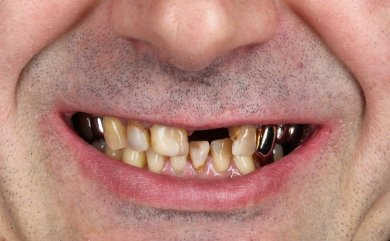Vorher-Ergebnis Zahnimplantat bei Dental Clinic Dynasty Stomatology in Prag, fehlende Zähne sichtbar