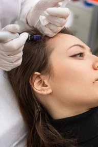 PRP-Haarausfallbehandlung in der Altos Clinic zur Haarwiederherstellung und Kopfhautgesundheit