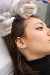 PRP-Haarausfallbehandlung in der Altos Clinic zur Haarwiederherstellung und Kopfhautgesundheit
