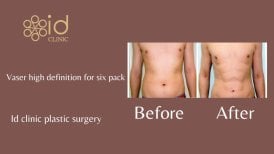 Vorher-nachher-Ergebnis Vaser High Definition Liposuktion Sixpack bei ID Clinic Bangkok