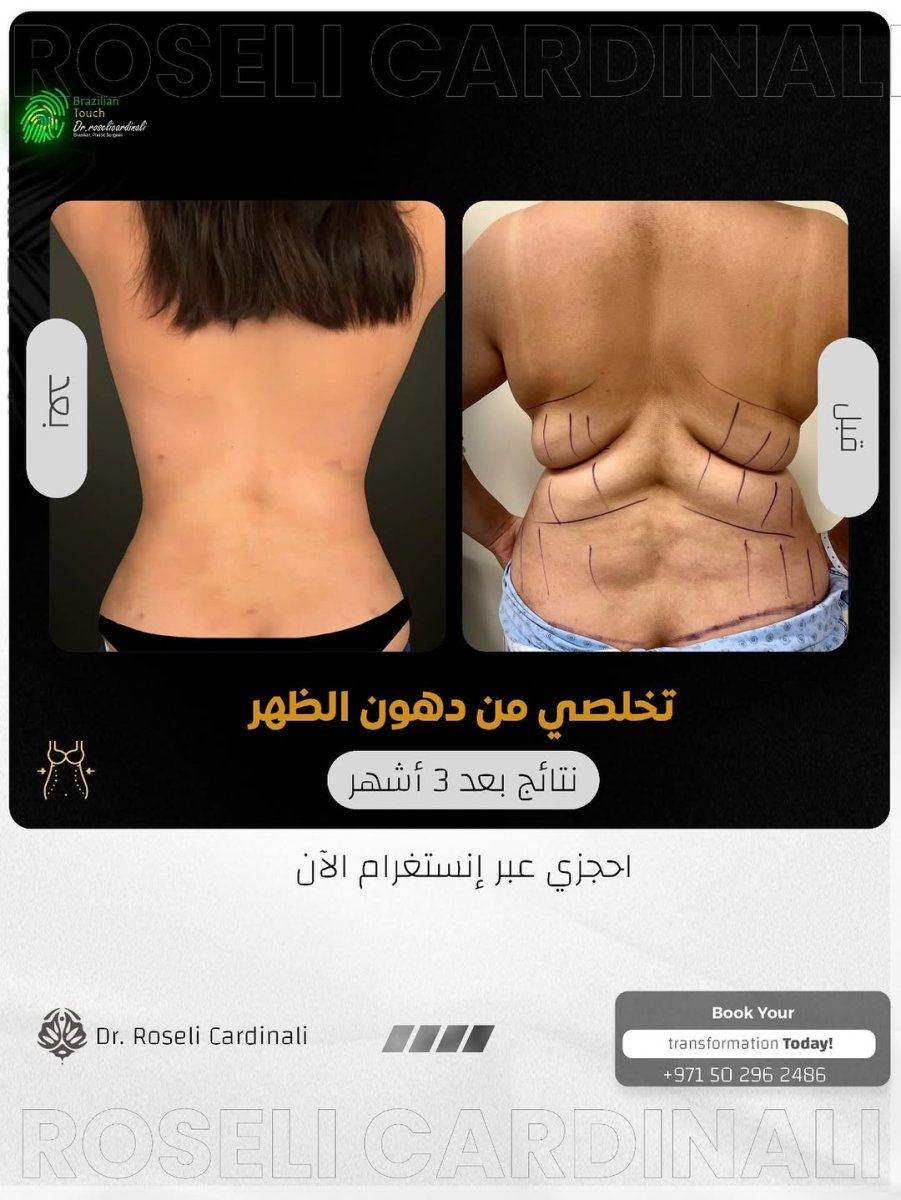 Antes y después de eliminación de grasa de la espalda en clínica Dr. Roseli Cardinali