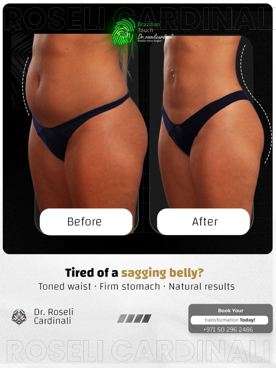 Resultados de abdominoplastia antes y después en Dr. Roseli Cardinali – abdomen firme