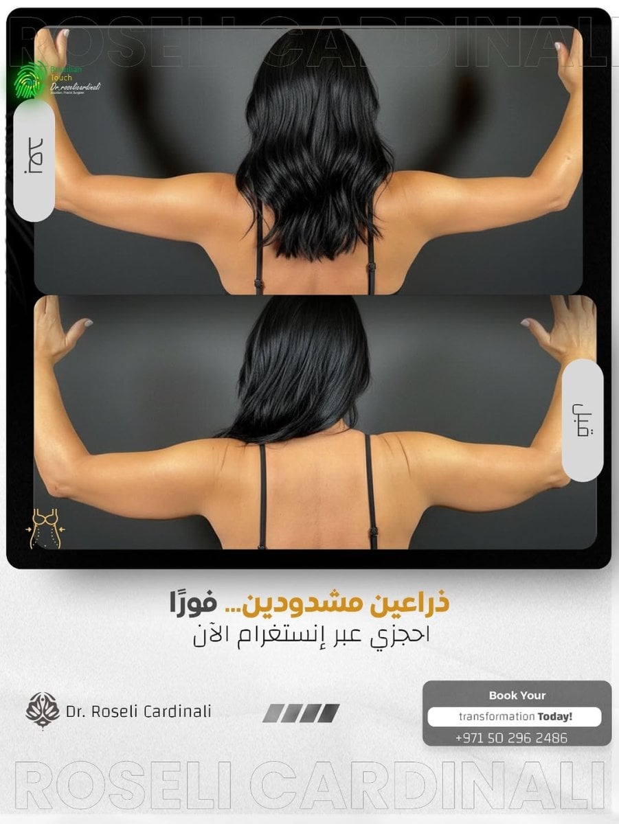 نتائج شد الذراعين (براكيوبلاستي) قبل وبعد في عيادة د. روسيلي كاردينالي