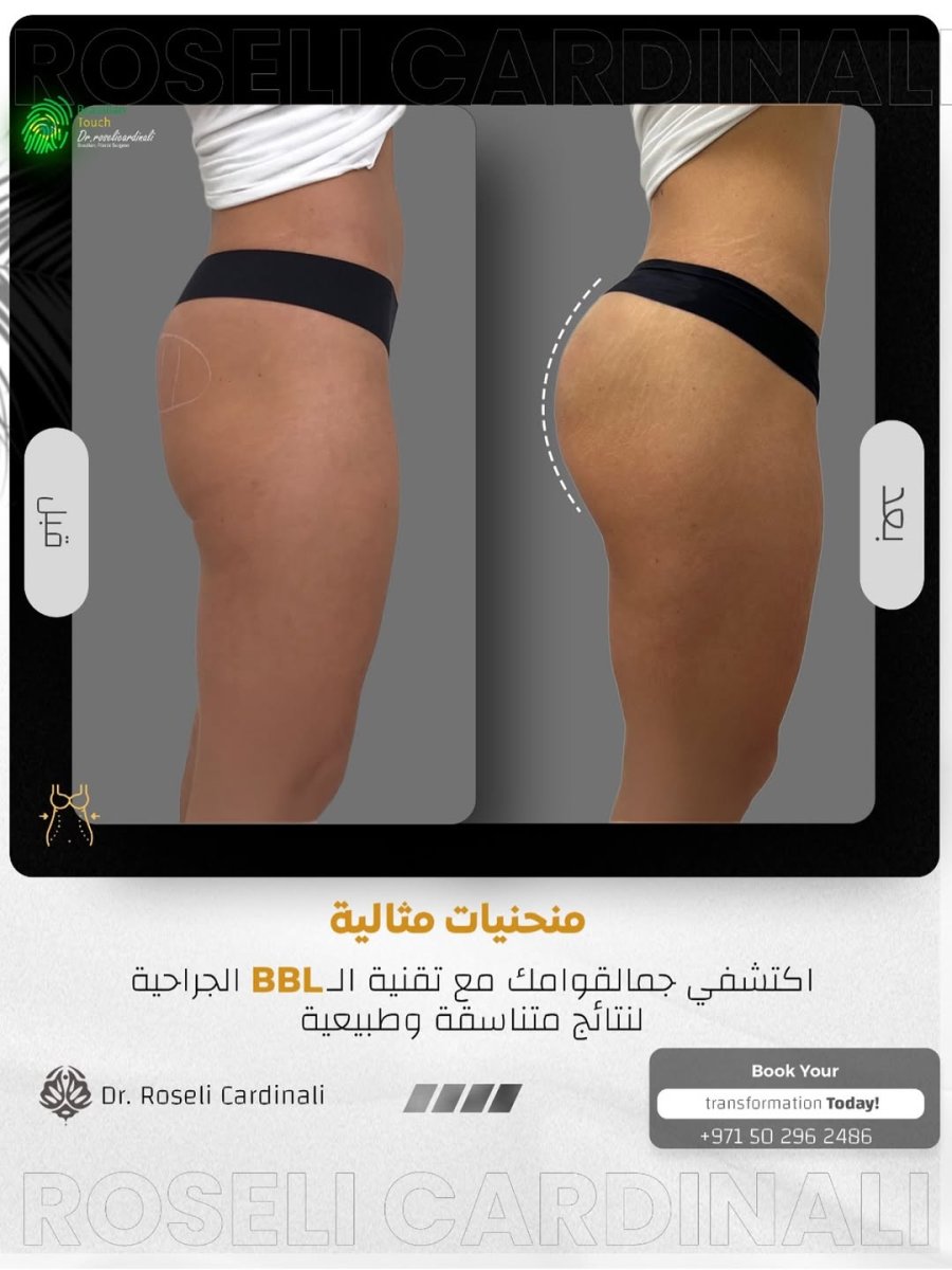 نتائج قبل وبعد عملية BBL في عيادة د. روسيلي كاردينالي، منحنيات محسّنة