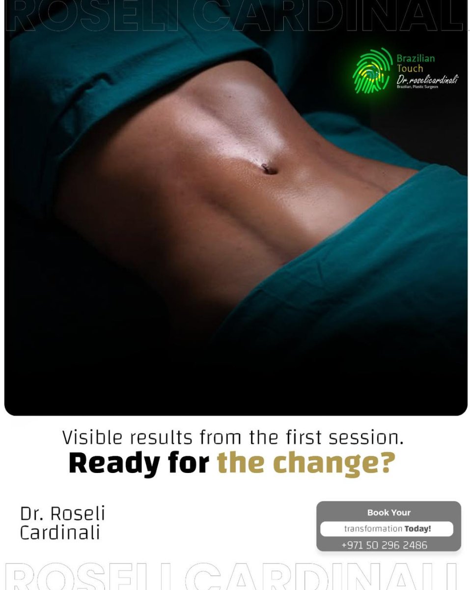 Resultado de liposucción abdominal en Brazilian Touch con la Dra. Roseli Cardinali – abdomen plano