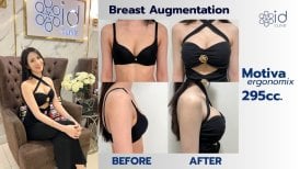 Vorher-nachher-Ergebnisse Brustvergrößerung bei ID Clinic Bangkok mit Motiva 295cc Implantaten