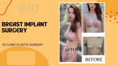Vorher-nachher-Ergebnisse Brustvergrößerung bei ID Clinic Bangkok, mehr Brustvolumen