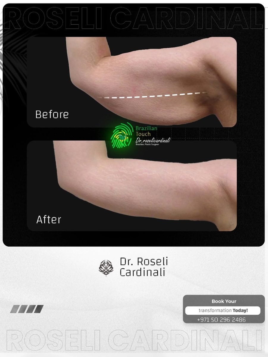 Resultados de lifting de brazos antes y después en la clínica Dr. Roseli Cardinali