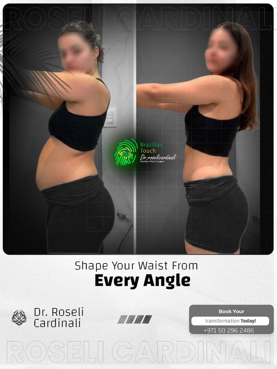 نتائج شفط الدهون 360 قبل وبعد لدى د. روسيلي كاردينالي، تحسين محيط الخصر