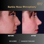 Vorher-nachher-Ergebnis Barbie-Nasenrhinoplastik bei ID Clinic Bangkok, verfeinerte Nase