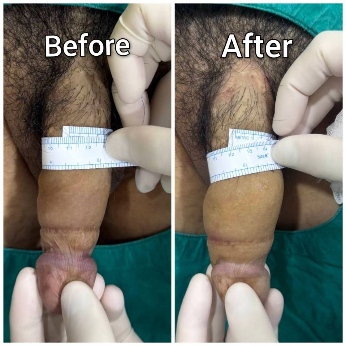 Resultados de aumento de pene antes y después en Eternity Clinic Pleonchit, mayor grosor