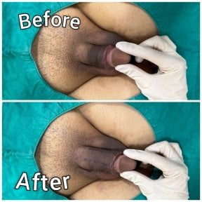 Before and after penis enlargement results at Eternity Clinic Pleonchit, visible size increase