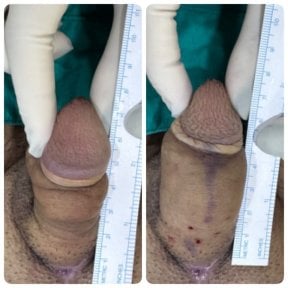 Before and after penis enlargement results at Eternity Clinic Pleonchit, visible length increase