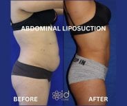 Vorher-nachher-Ergebnis 360-Liposuktion bei ID Clinic Bangkok, sichtbare Bauchkontur