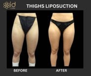 Vorher-nachher-Ergebnis Oberschenkel-Liposuktion bei ID Clinic Bangkok, schlankere Kontur