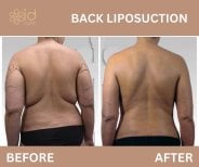 Ergebnisse Rückenliposuktion vorher und nachher bei ID Clinic Bangkok – sichtbare Fettreduktion
