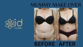 Vorher-nachher-Ergebnis Mommy Makeover bei ID Clinic Bangkok – sichtbare Körperkonturverbesserung