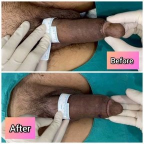 Vorher-nachher-Ergebnisse Penisvergrößerung bei Eternity Clinic Phuket By Dr.Beer, sichtbare Zunahme