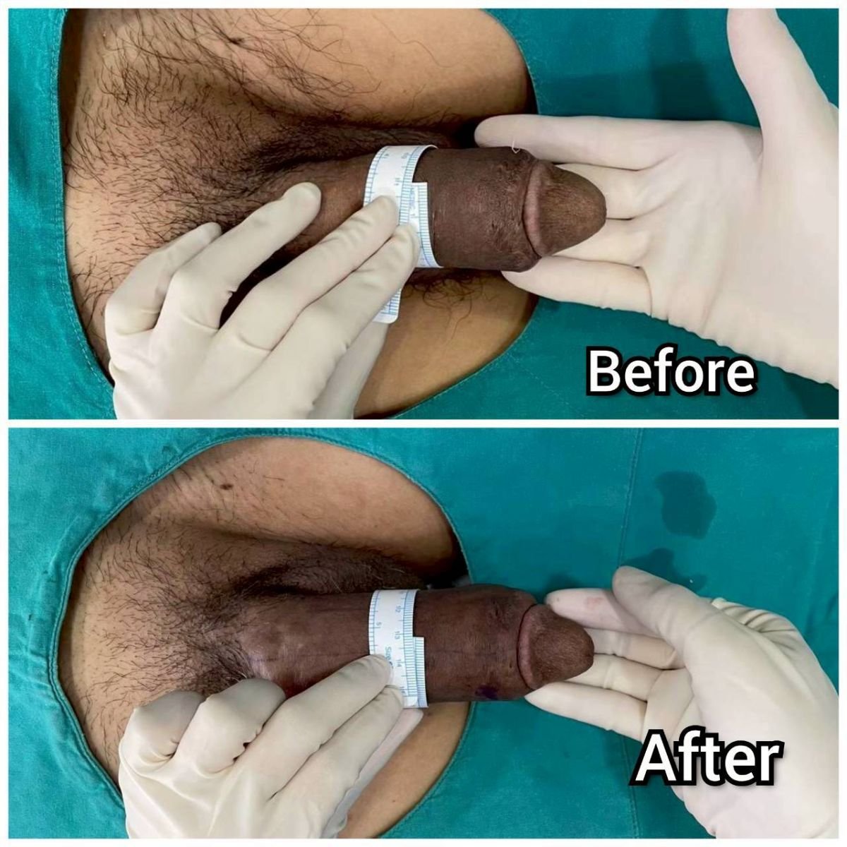 نتائج تكبير القضيب قبل وبعد في Eternity Clinic Phuket By Dr.Beer، زيادة المحيط