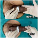 Vorher-nachher-Ergebnisse Penisvergrößerung bei Eternity Clinic Phuket By Dr.Beer, mehr Umfang