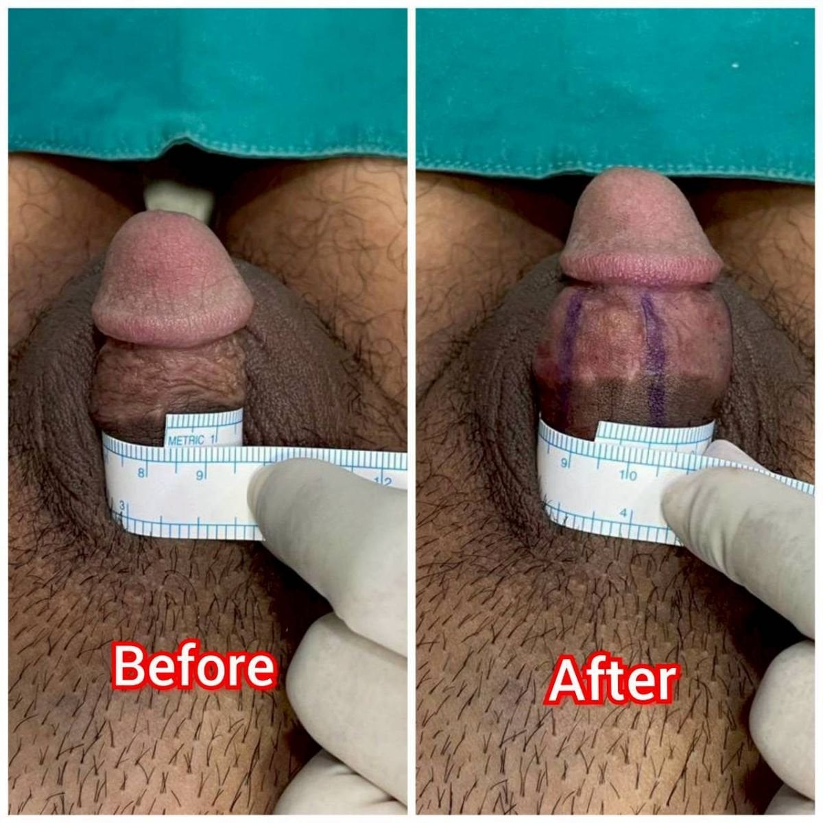 Resultados de aumento de pene antes y después en Eternity Clinic Phuket By Dr.Beer, mayor grosor
