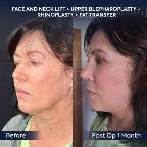 before-after photo deep-plane-facelift
