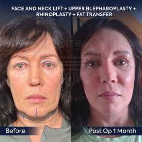 before-after photo deep-plane-facelift