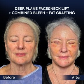 before-after photo deep-plane-facelift