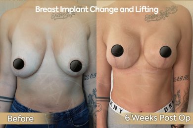 before-after photo breast-implant-revision