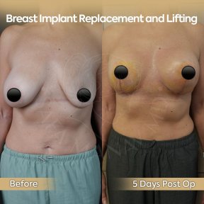 before-after photo breast-implant-revision