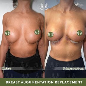 before-after photo breast-implant-revision