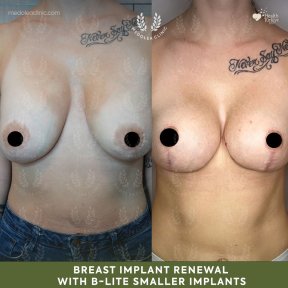 before-after photo breast-implant-revision