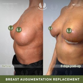 before-after photo breast-implant-revision