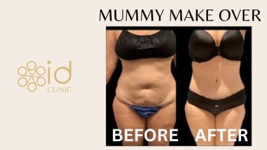 before-after photo mastopexy-breast-lift-contour-plastics
