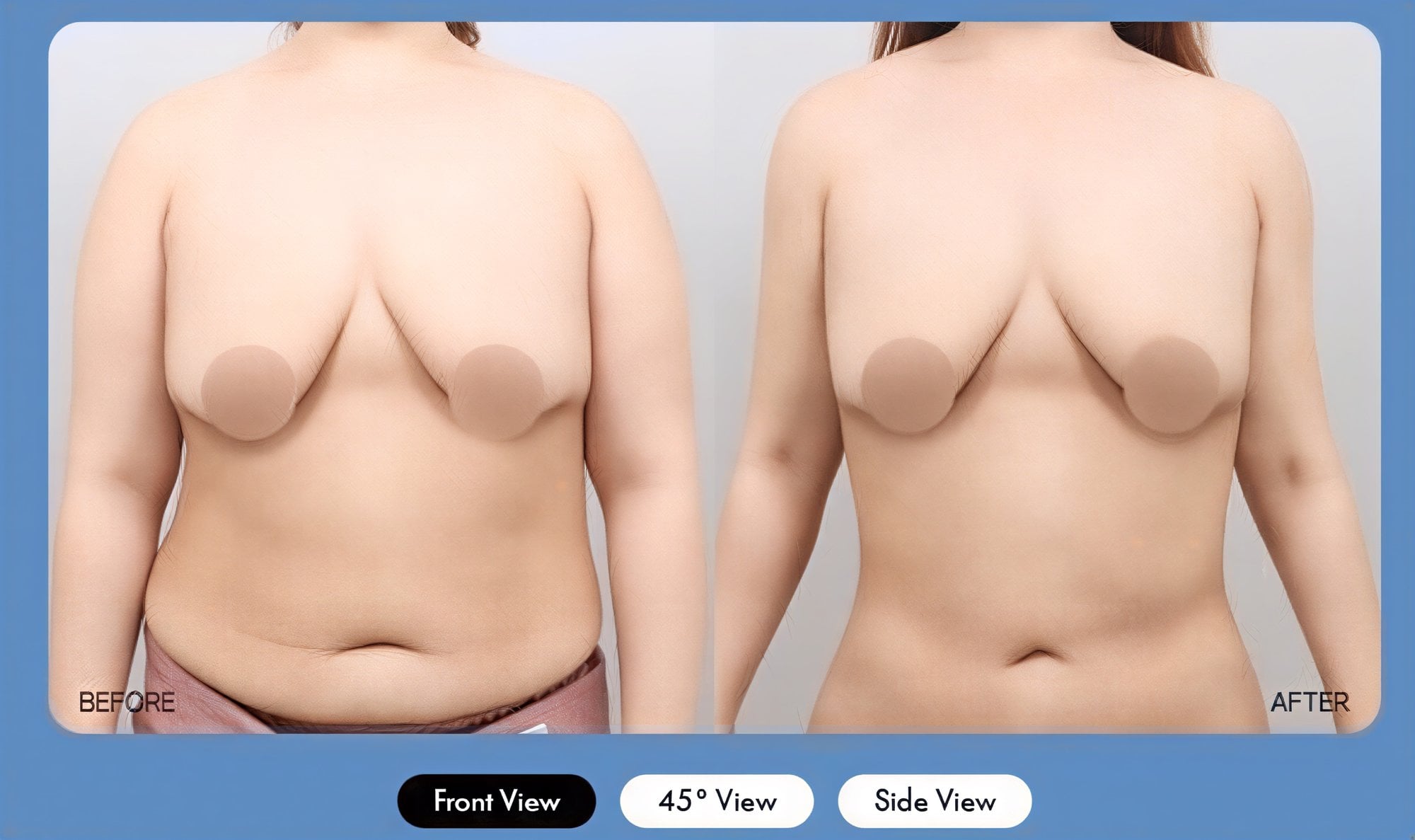 Resultados de liposucción antes y después en AB Plastic Surgery Clinic, abdomen mejorado