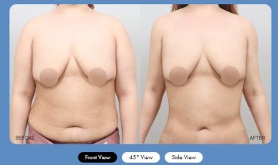 Before and after liposuction results at AB Plastic Surgery Clinic, improved abdominal contour