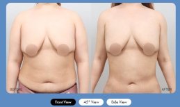 Before and after liposuction results at AB Plastic Surgery Clinic, improved abdominal contour