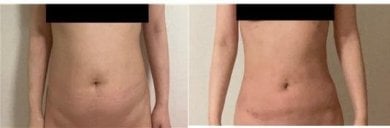 Before and after liposuction results at AB Plastic Surgery Clinic, improved abdominal contour