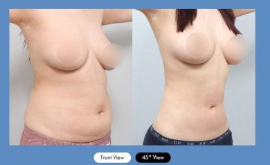 Before and after liposuction results at AB Plastic Surgery Clinic, improved abdominal contour