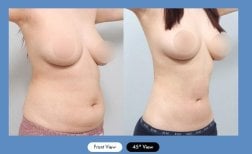 Before and after liposuction results at AB Plastic Surgery Clinic, improved abdominal contour