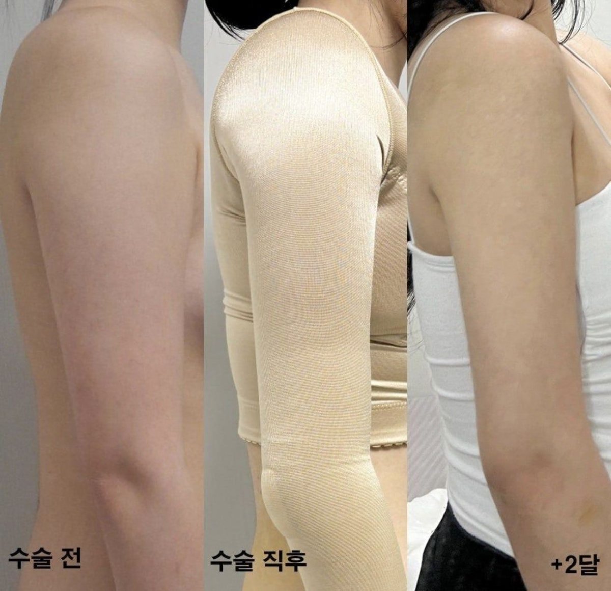 نتائج شفط دهون الذراع قبل وبعد في AB Plastic Surgery Clinic، ذراع أنحف